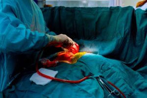 Read more about the article Coronary Angioplasty Surgery In Bangalore