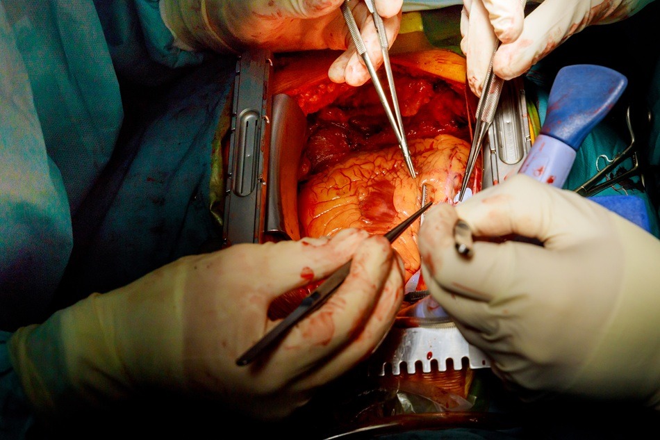 You are currently viewing Laparoscopic Hysterectomy Surgery In Bangalore